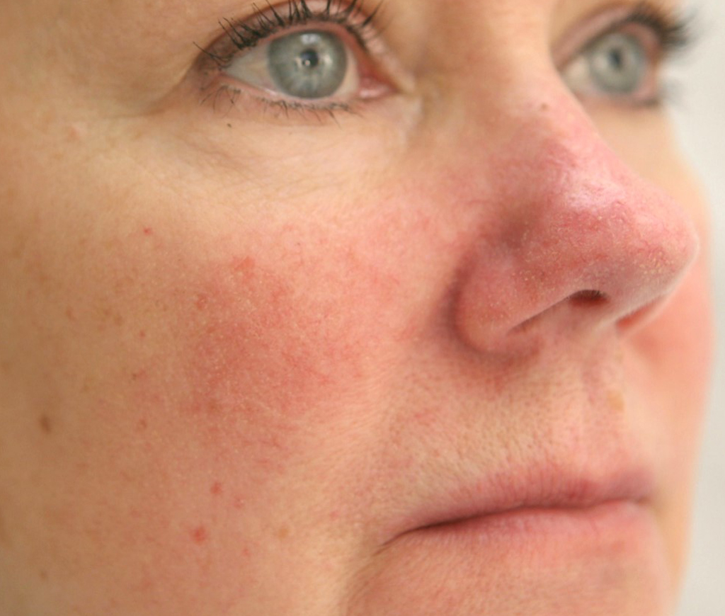 IPL Laser Treatments Sun Spot Removal, Rosacea Treatments in Santa