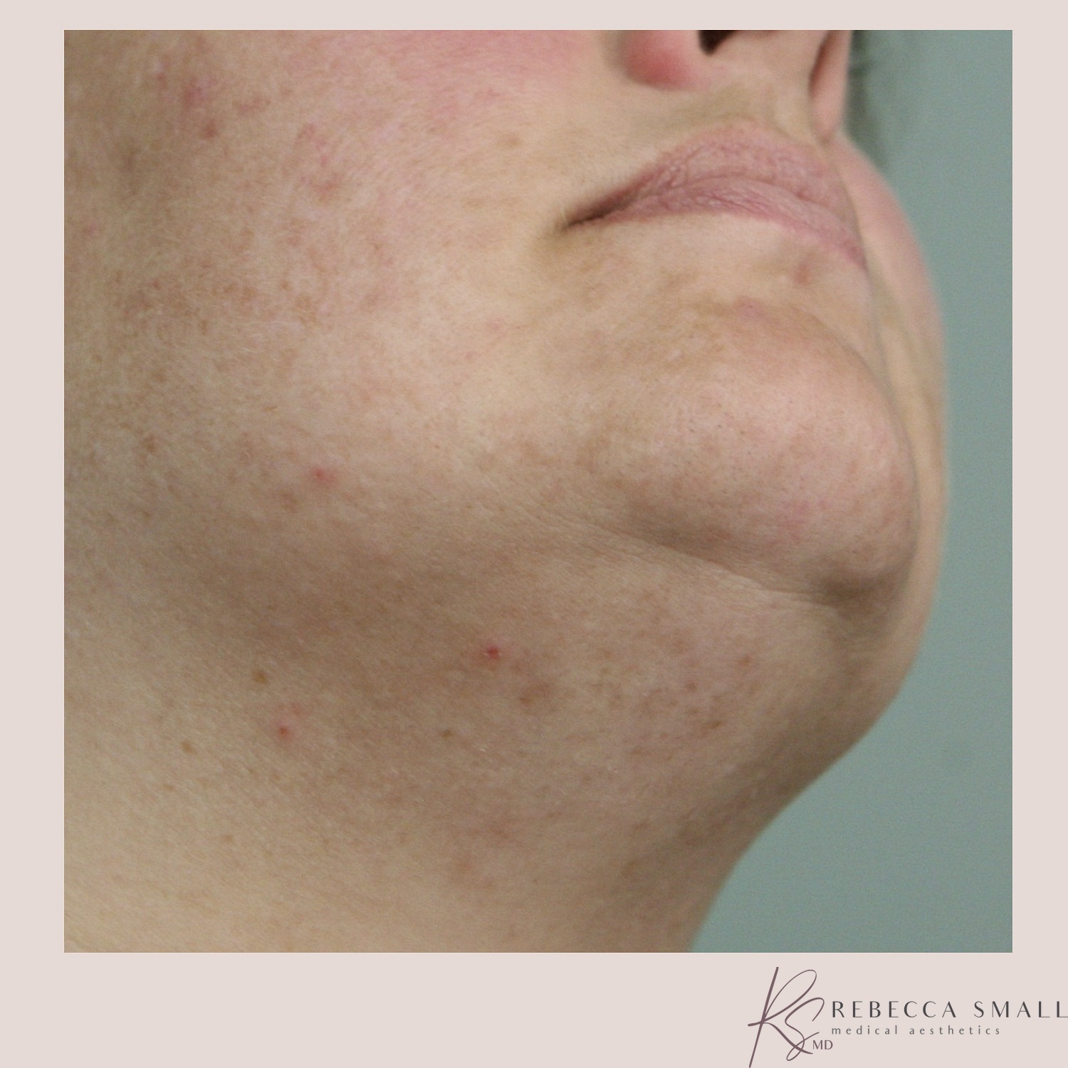 Laser Hair Removal Razor Bump & Ingrown Hair Treatment in Santa Cruz, CA