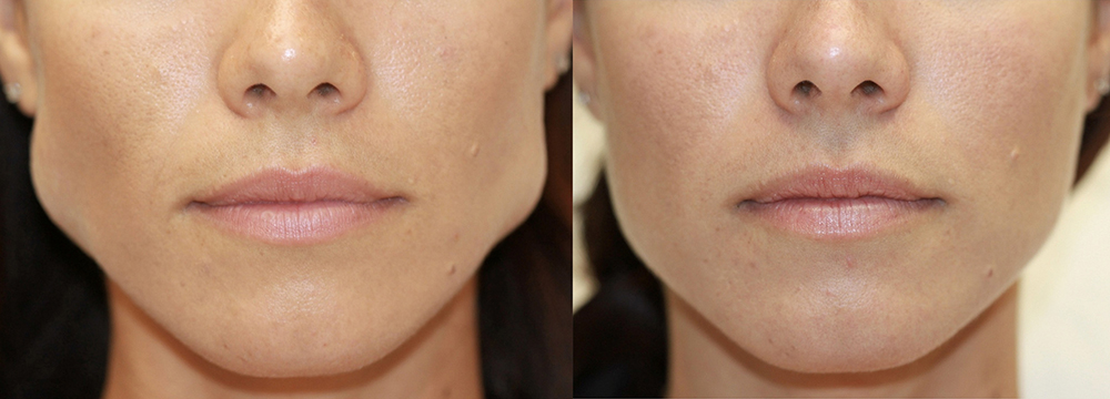 Before & After Masseter Jaw Botox Photos 