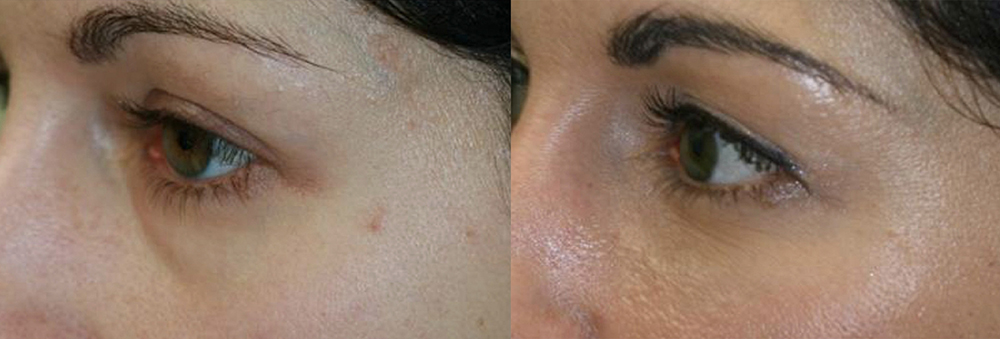 TearTroughs Under Eye Filler:<br />Get Rid of Dark Circles & Tear Trough Hollows in Santa Cruz